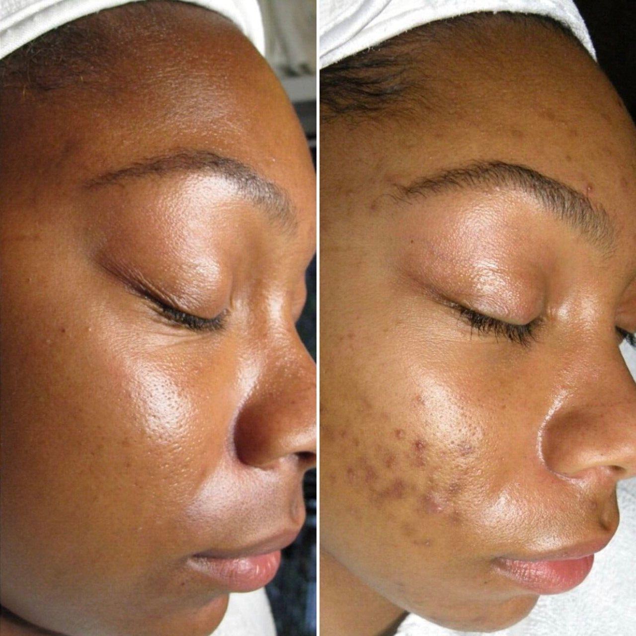 Turmeric Exfoliating Pads - Turmeric & Kojic Acid Brightening Pads - Arabel's Naturals