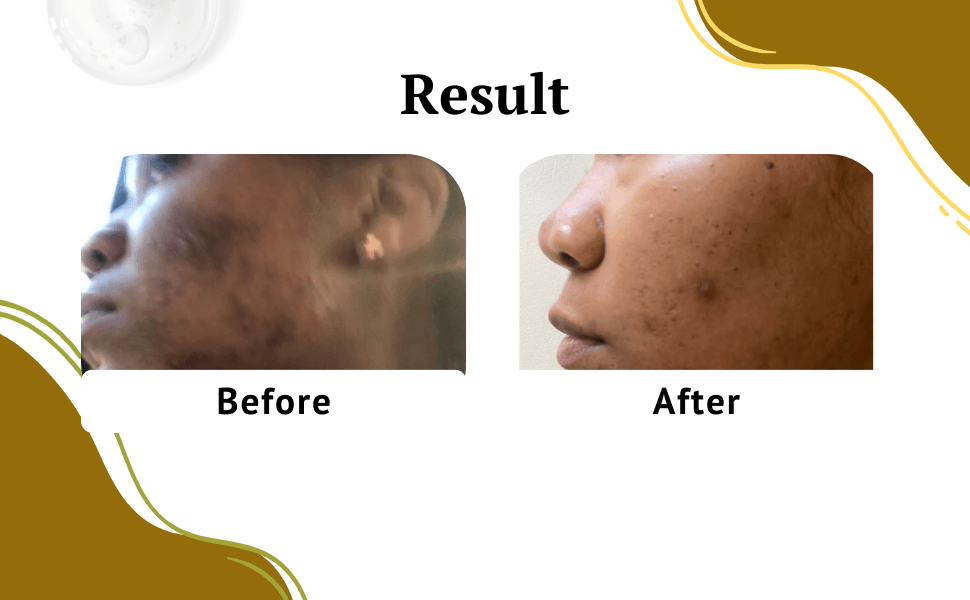 turmeric for dark spots