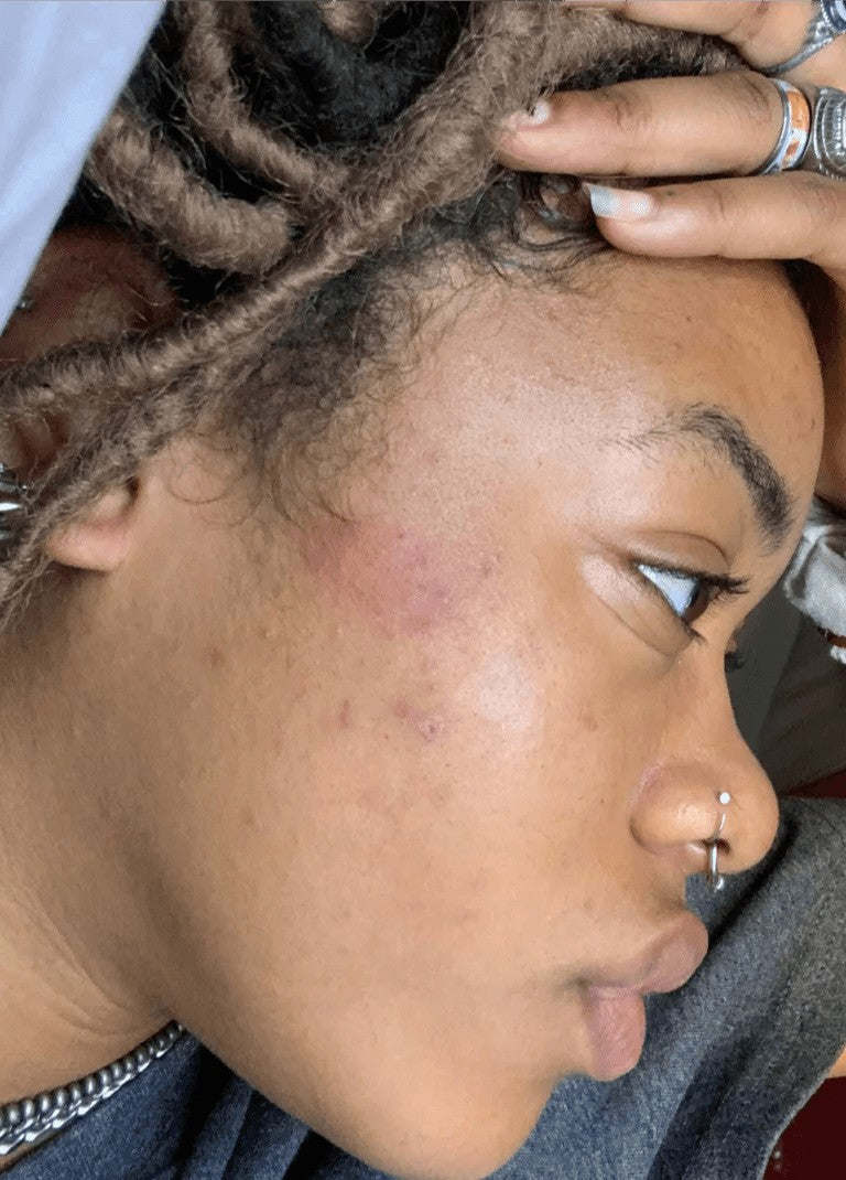 After: customer skin after 6 weeks of Arabel's Naturals turmeric soap