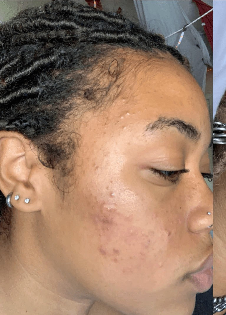 Before: customer skin before using Arabel's Naturals turmeric soap