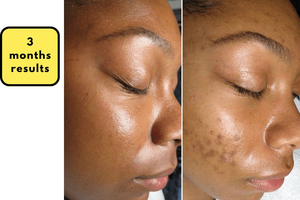 Real customer results after 3 months with Arabel's Naturals