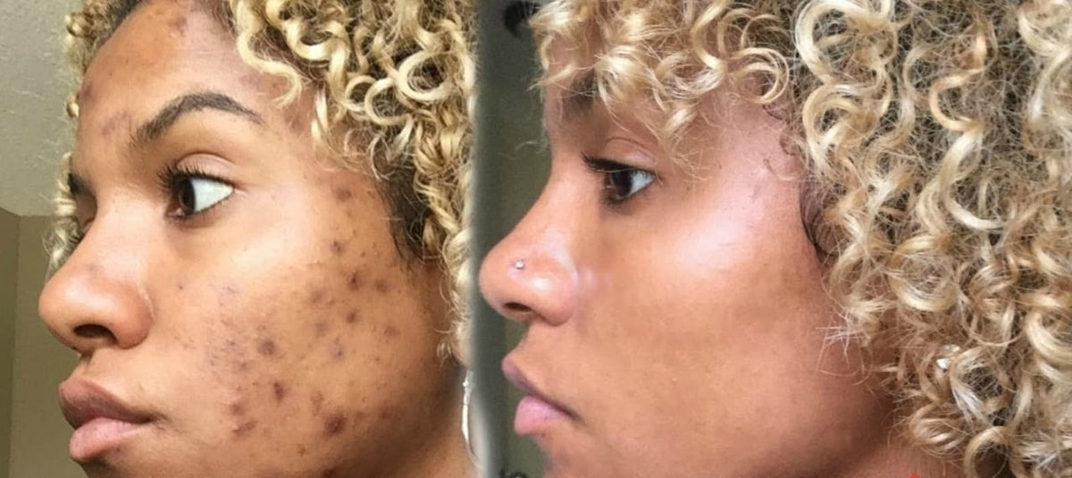 Real customer before and after dark spot results with Arabel's Naturals